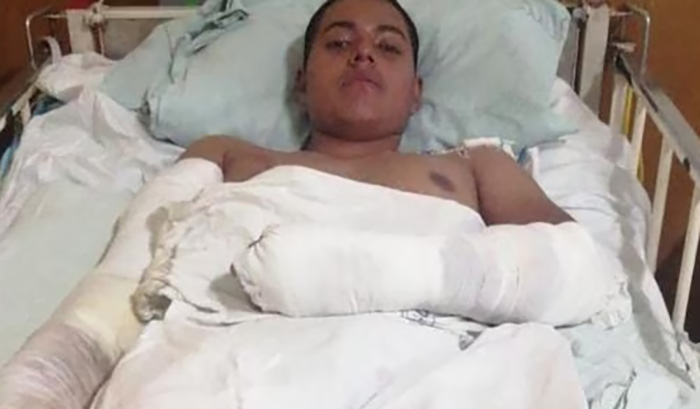 Tacna: amputan brazo a soldado que sufriÃ³ fuerte descarga elÃ©ctrica
