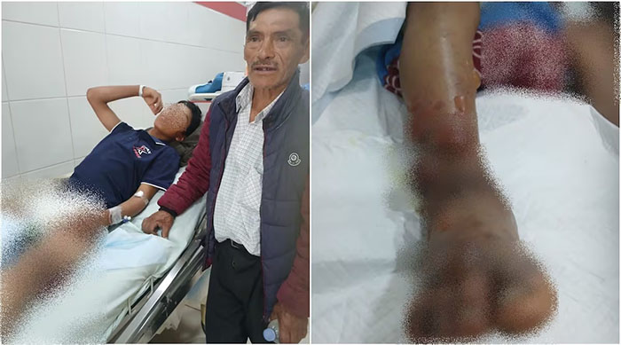 Huancavelica: víbora ataca a menor y veneno se prolongó rápidamente dejándolo en el hospital