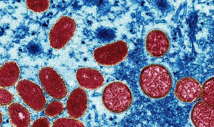 Arequipa: confirman 3 nuevos casos de viruela del mono, suman 5 en total