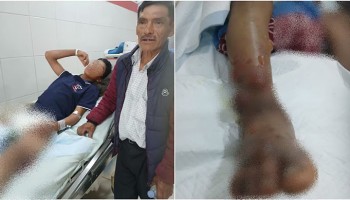 Huancavelica: víbora ataca a menor y veneno se prolongó rápidamente dejándolo en el hospital