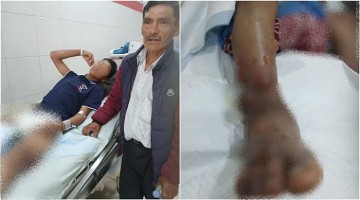 Huancavelica: víbora ataca a menor y veneno se prolongó rápidamente dejándolo en el hospital