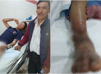 Huancavelica: víbora ataca a menor y veneno se prolongó rápidamente dejándolo en el hospital