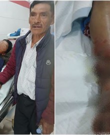 Huancavelica: víbora ataca a menor y veneno se prolongó rápidamente dejándolo en el hospital