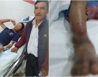 Huancavelica: víbora ataca a menor y veneno se prolongó rápidamente dejándolo en el hospital