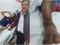 Huancavelica: víbora ataca a menor y veneno se prolongó rápidamente dejándolo en el hospital