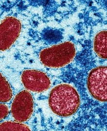 Arequipa: confirman 3 nuevos casos de viruela del mono, suman 5 en total
